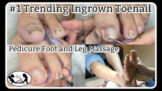 👣 #1 Trending Ingrown Toenail Cleaning Pedicure Foot Massage and Nail Shape Correction 👣 👣 #1 Trending Ingrown Toenail Cleaning Pedicure Foot Massage and Nail Shape Correction 👣