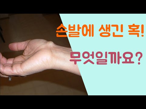 [닥터홍선생]#10.손과 발에 생긴 혹! 무엇일까요? (결절종, 진단 & 치료법)