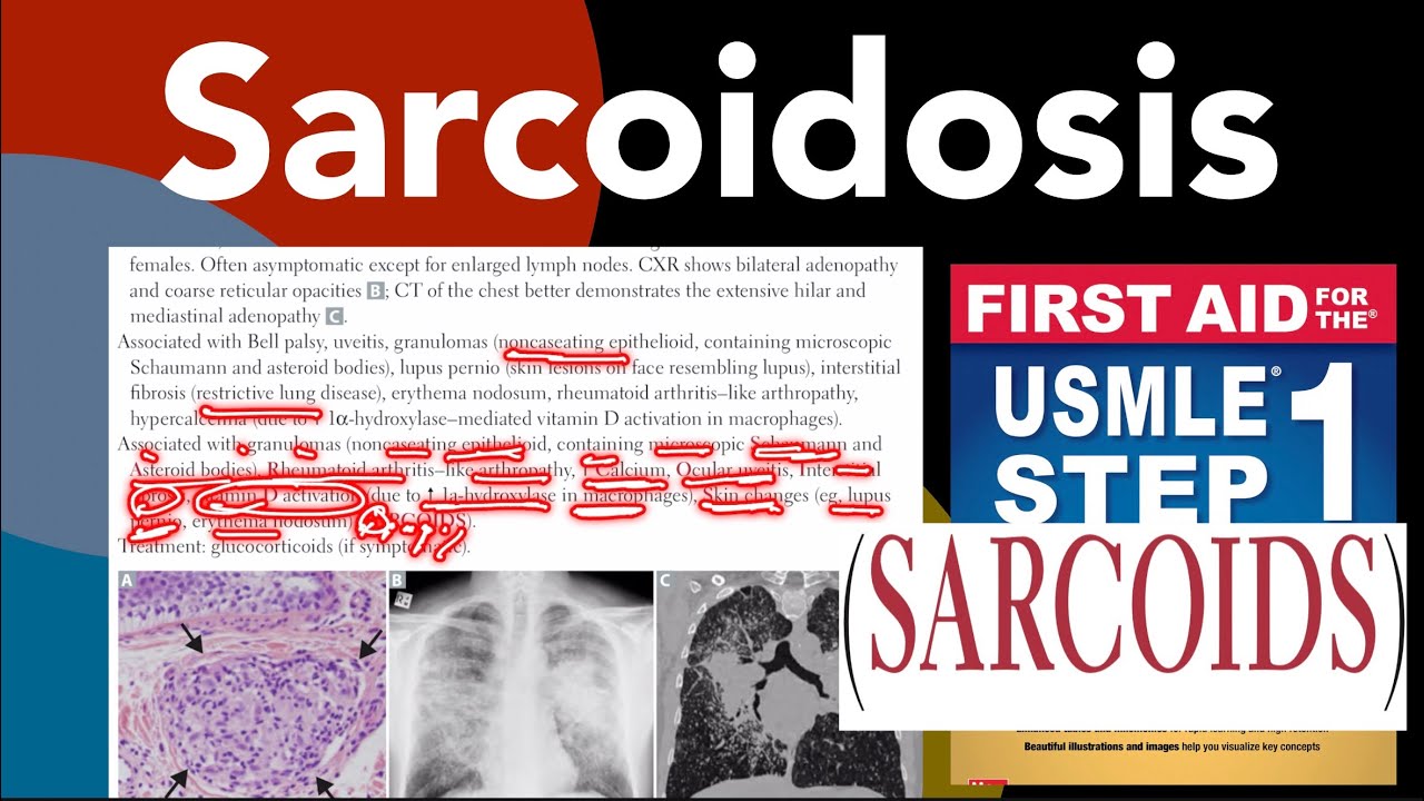 Sarcoidosis in Hindi/Urdu by first aid for USMLE step 1 - YouTube