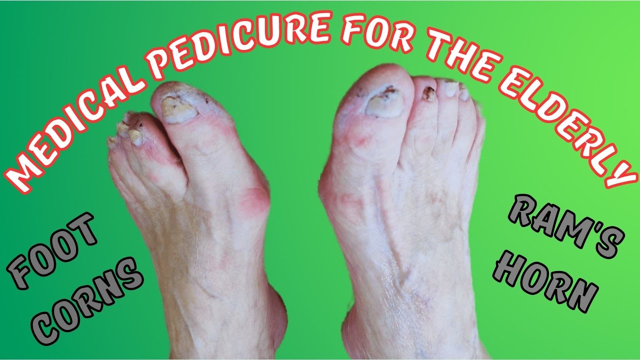 Medical pedicure for the elderly. Rams horn. Corns YouTube