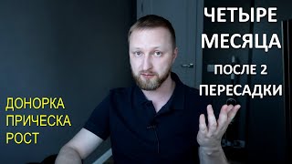 ЧЕТЫРЕ МЕСЯЦА ПОСЛЕ ВТОРОЙ ПЕРЕСАДКИ ВОЛОС