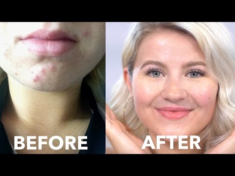 HOW TO: Cure Acne Naturally | Fast & Cheap | Milabu