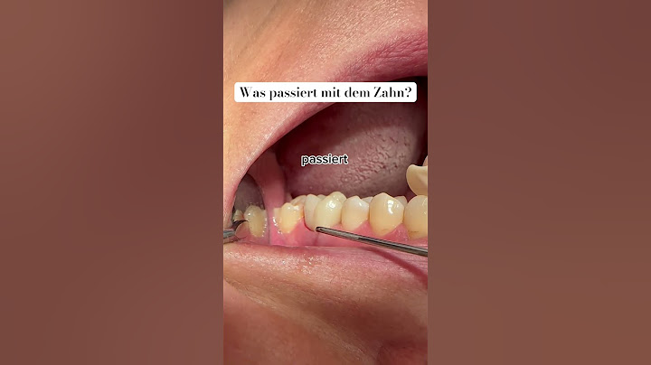 Wisst Ihr was mit dem Zahn passiert? #zahnarzt #schönezähne