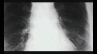 Crommelin Fibroseal new video
