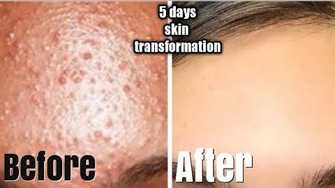5 DAYS SKIN TRANSFORMATION CHALLENGE: Remove Tiny Bumps Open pores