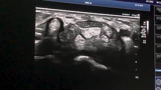 Ultrasound Of A Swollen Motor Branch Of The Median Nerve