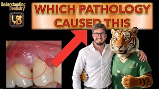 Lichen Planus vs. Pemphigoid vs. Pemphigus: Desquamative Gingivitis | Oral Medicine