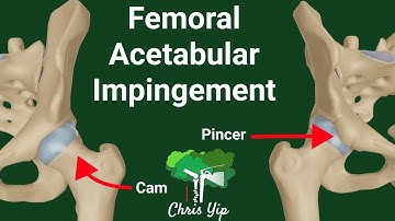 Femoral Acetabular impingement (FAI) Explained (Animated)