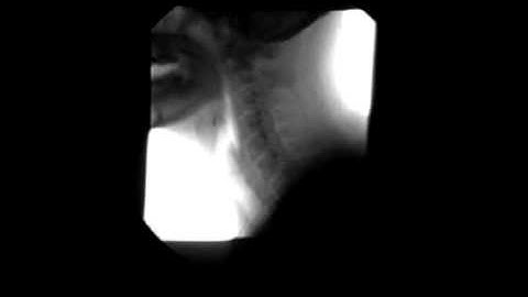 Curing of Oscillating Larynx by Levetiracetam Part 2