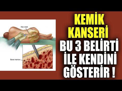 Kemik Kanseri Bu 3 Belirti İle Kendini Gösterir !
