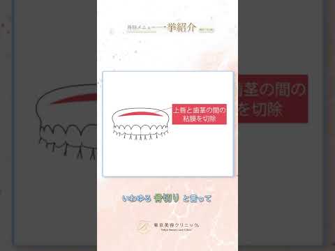 『ガミースマイル』“超” 簡単解説 #美容整形 #東京美容クリニック #Shorts #美容整形 #東京美容クリニック #Shorts