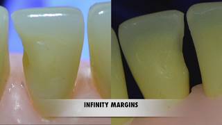Class III cavity preparation for Resin Composite