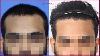 Great Hairline & Density I 10 months I Hair Transplant Result @EugenixHairSciencesofficial