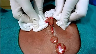 Sebaceous cyst - YouTube