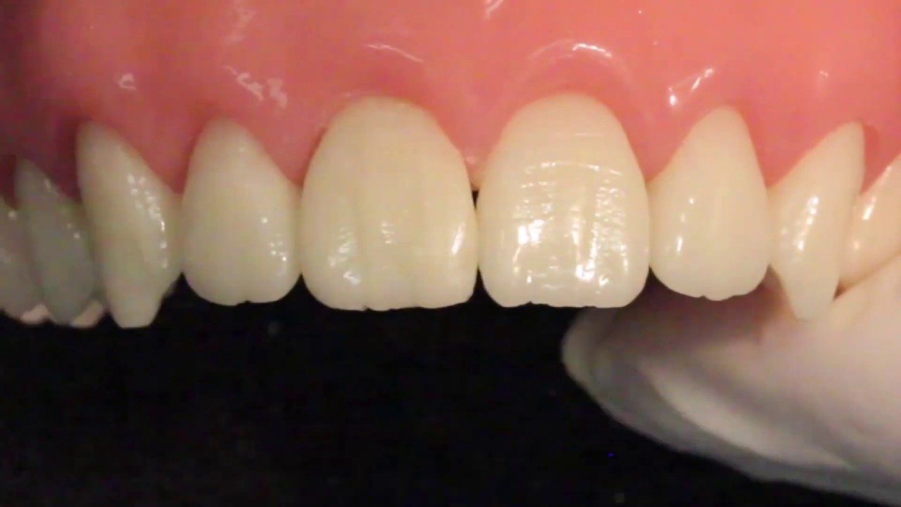 Técnica Simplificada de fechamento de diastemas