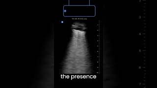 Lung Ultrasound: B-lines (Ring Down Artifact)  #pocus #ultrasound  #pneumothorax #pulmonaryedema