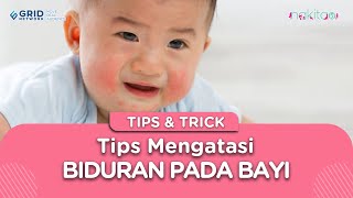 PERHATIKAN! Tips ini untuk Atasi Biduran pada Bayi