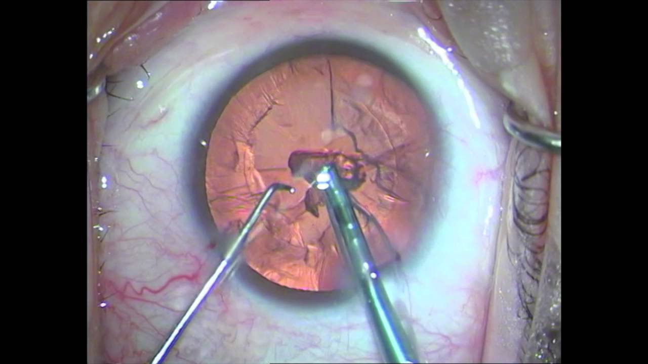 Maculopatia Causata Da Intervento Cataratta Intervento di cataratta su paziente con forte miopia - YouTube