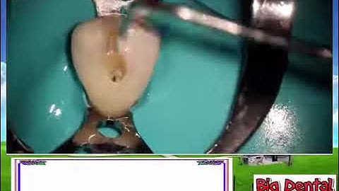 14  Mở tủy răng nanh hàm dưới Carlos Praco