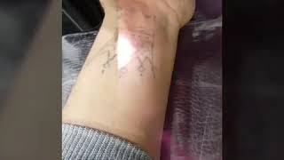 الحصة الثانية من ازالة الوشم. Remove tattoo