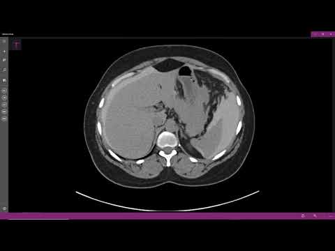 Ruptura vesical intraperitoneal