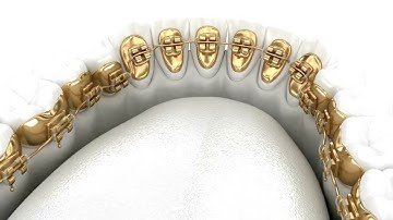 Niềng răng mặt trong Lingual braces