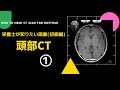 #45の①【栄養士が知りたい画像(初級編)_頭部CT】How to Read  Head CT scan for Dietitian