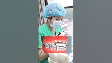 Độ tuổi thích hợp để niềng răng #shorts #nhakhoahanoisydney #niengrang