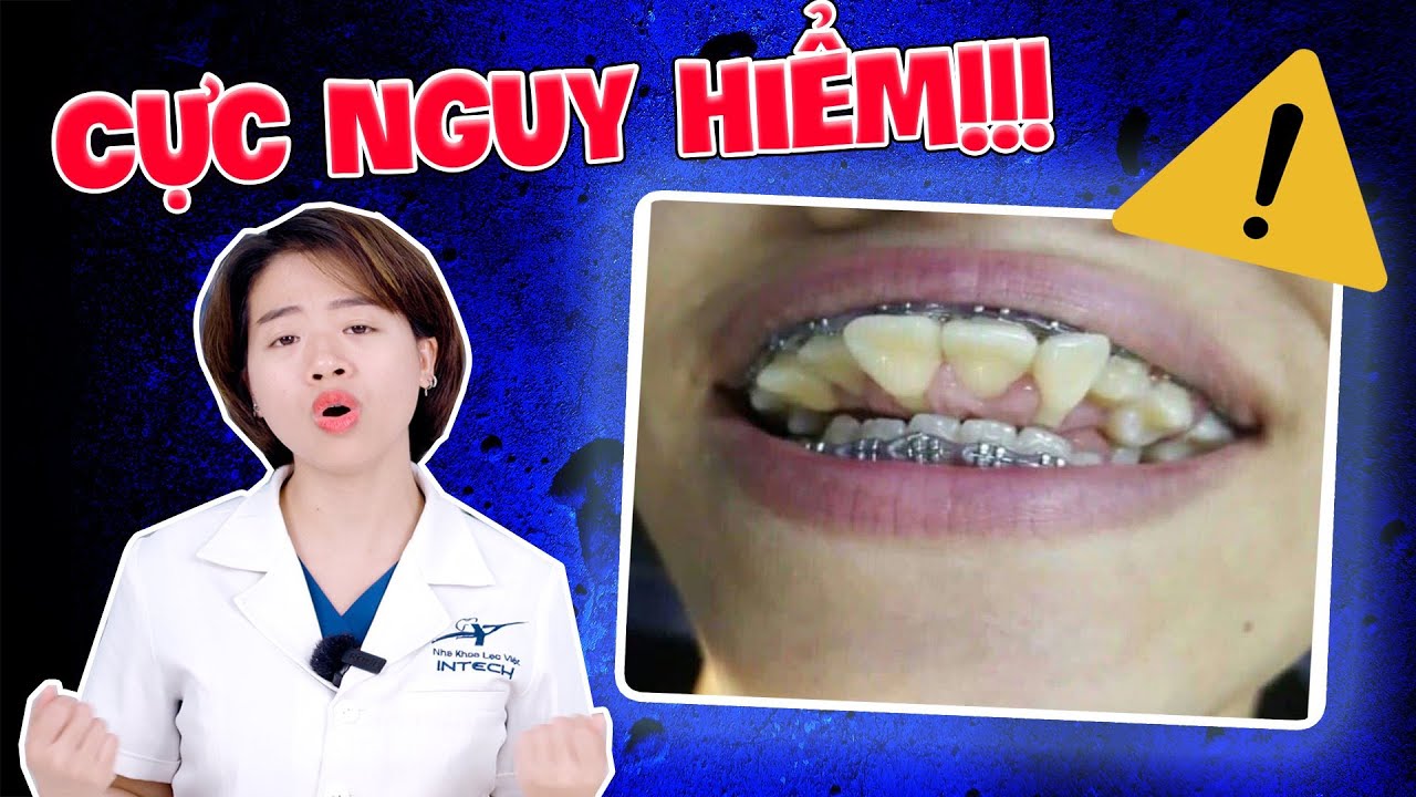 Outline Video Tác Hại Của Niềng Răng: 5 Tác Hại Của Niềng Răng "Khiếp Sợ" Nhất (99,9% Do Niềng Răng Hỏng)