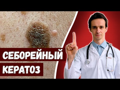 Себорейный кератоз 🧓 Что это и как лечить?