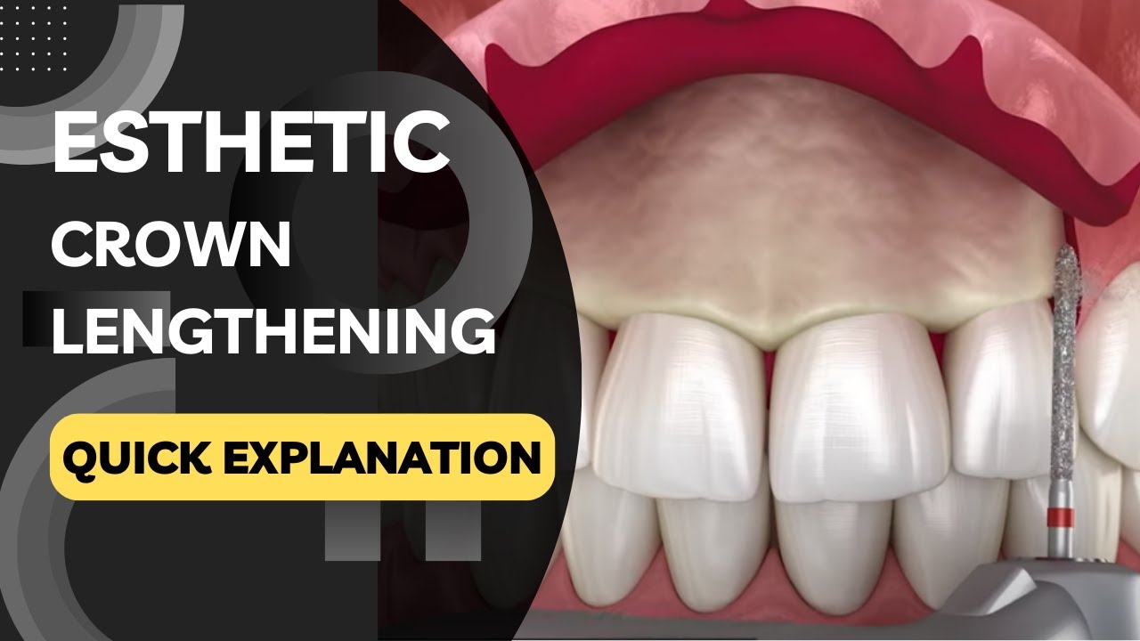 What is Esthetic Crown Lengthening? Quickly Explained in a Few Seconds!
