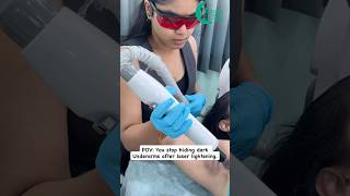 Laser Carbon Peel for Underarm Lightening