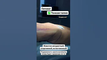Сделали липосакцию живота и боков, получили тонкую талию и плоский живот! Видео до и после операции