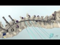 NILE™ Alternative Fixation Spinal System Product Animation