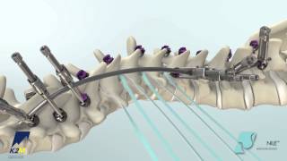 NILE™ Alternative Fixation Spinal System Product Animation