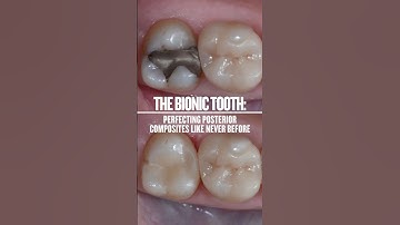 The Bionic Tooth: Perfecting Posterior Composites Like Never Before! 🦷
