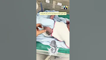 ماهي الولادة المقعدية ولماذا تمثل 3 4 من كل 100 ولادة حالة غريبة بس طبيعية 