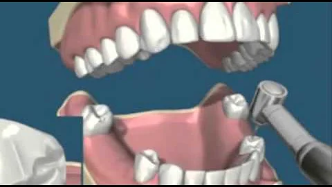 Dentures Treatment