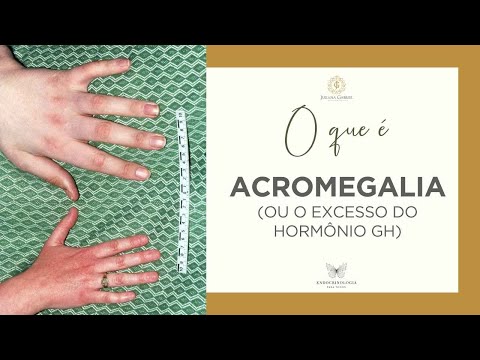 Excesso de GH: quais as causas e sintomas? | Acromegalia & Gigantismo