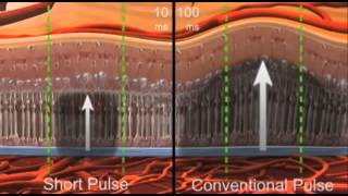 PASCAL   Pattern Scanning Laser introduction