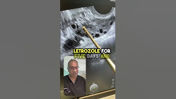 PCOS- LETROZOLE FAILED