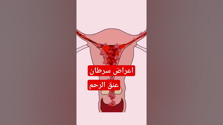 اعراض سرطان عنق الرحم .. انتبهي على حالك