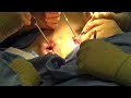Estrofia Vescicale e Micropene  Falloplastica con gran dorsale + impianto di protesi peniena
