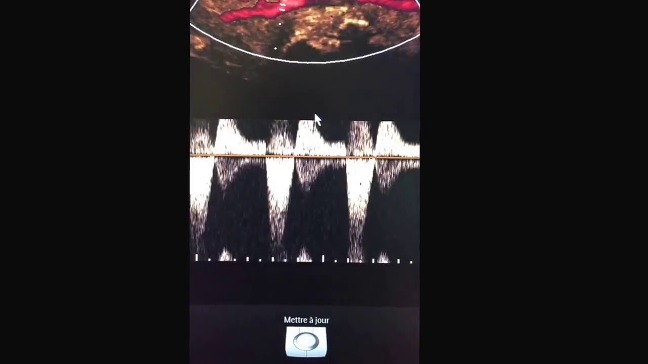 Dissection artère poplitée écho camera iphone 8 plus apk
