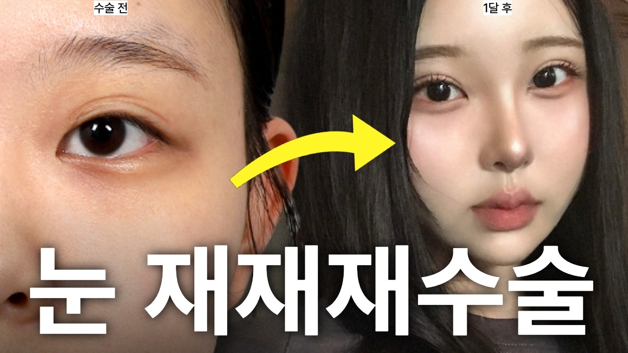 [Вандерфул гоо сайхны мэс засал] Нүдний дахин заслын сүүлчийн хагалгаа юм. Дизайныг ингэж хийнэ. 1 сарын дараа.