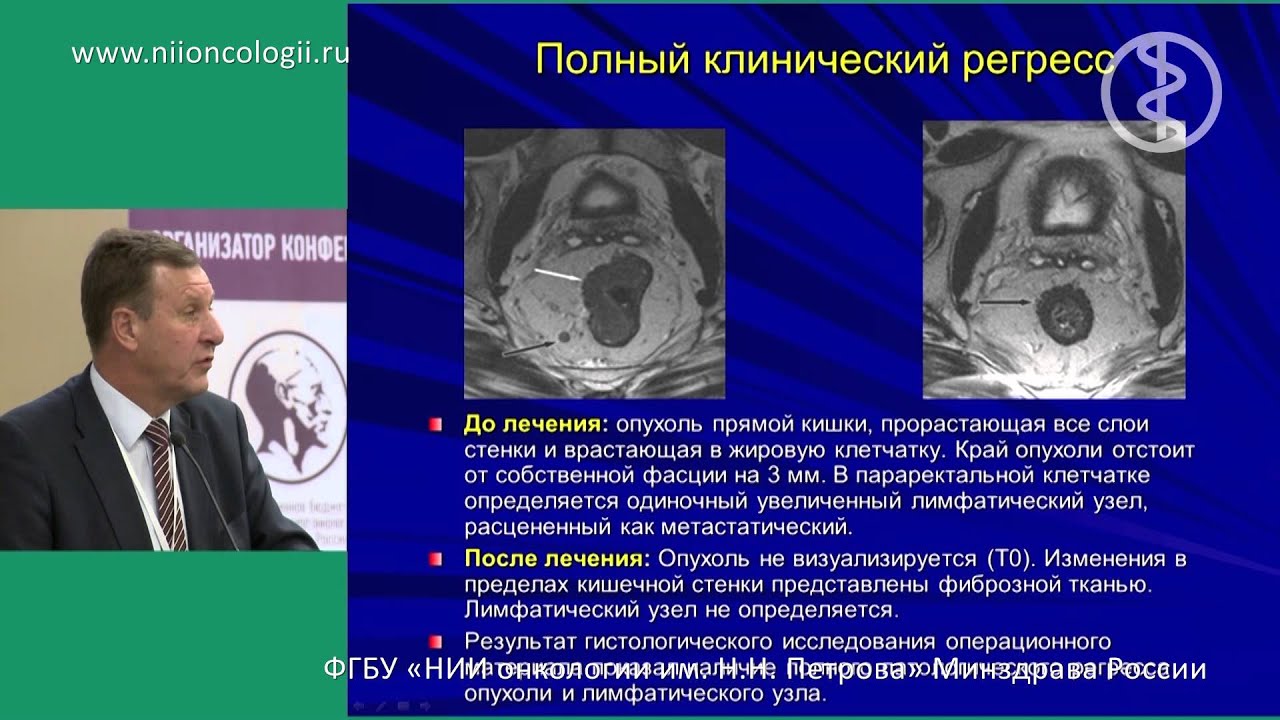 Комбинированное лечение рака прямой кишки: кому и зачем? (И.В. Правосудов)
