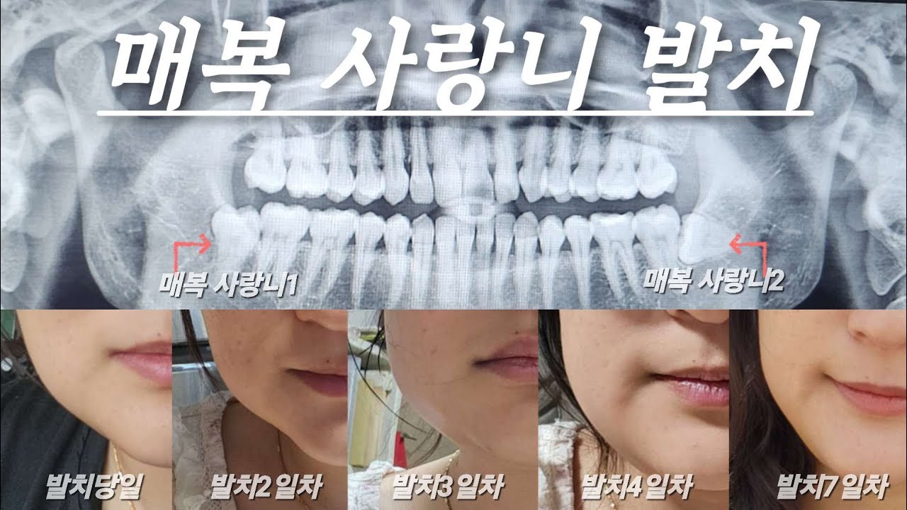 [HYEONI VLOG] 드디어 뽑았다..🦷매복 사랑니 발치 브이로그 ㅠㅠ (진짜 아픔)