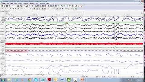 24. RemLogic Navigating in a Study