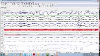 24. RemLogic Navigating in a Study