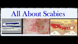 Everything You Need to Know About Scabies..كل ما تحتاج لمعرفته حول  فطر ومرض الجرب